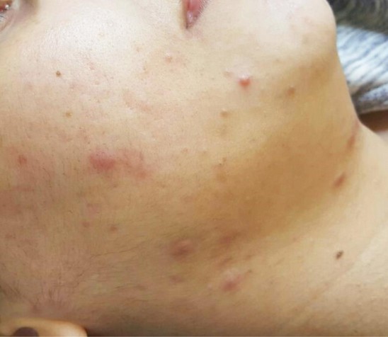 Before advanced layer acne treatment