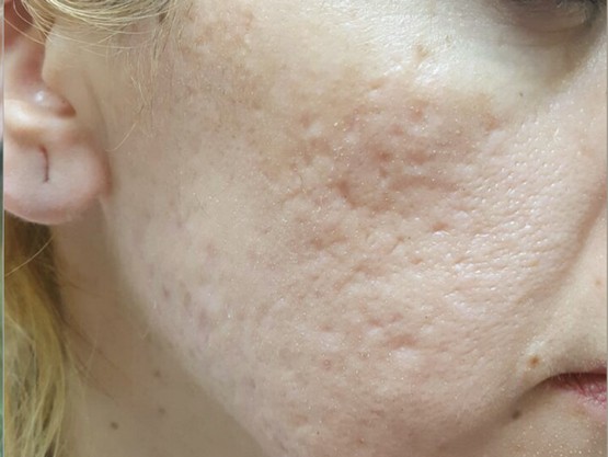 Results of skin treatment with less acne