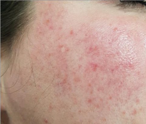 Rosacea Treatment - NewSkin