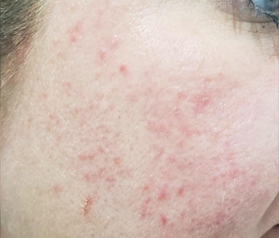 rosacea image after results