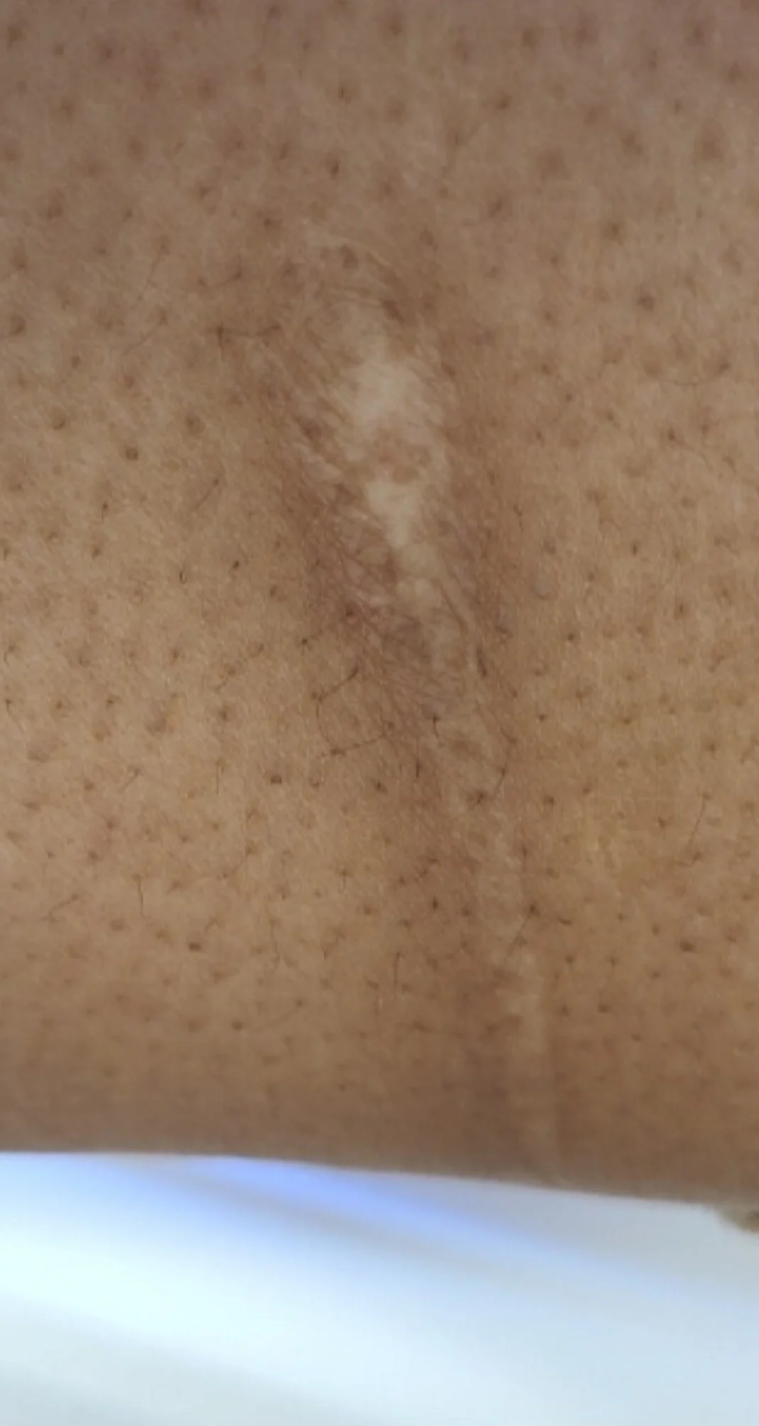 Before treatment 1
