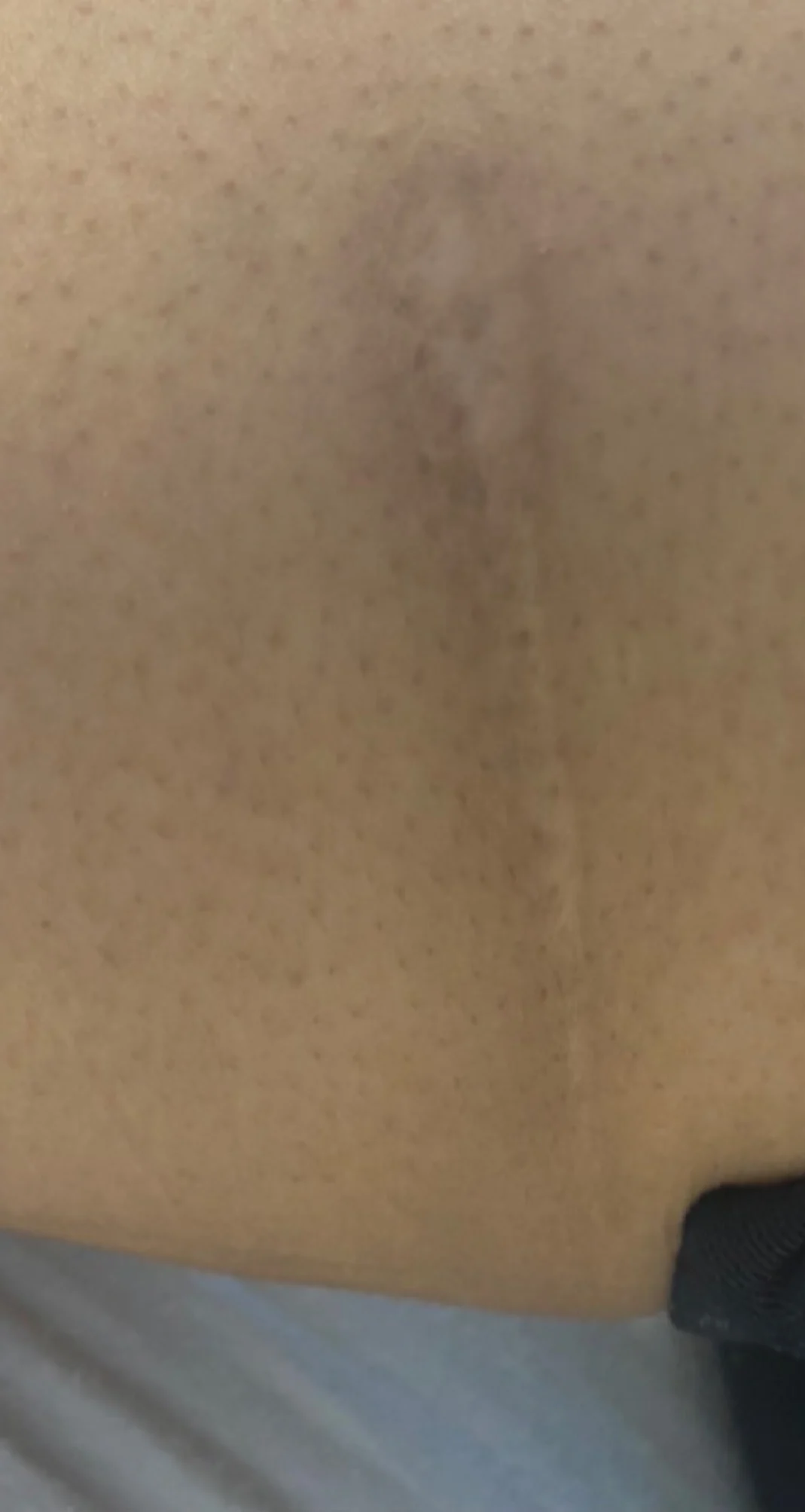After treatment 1