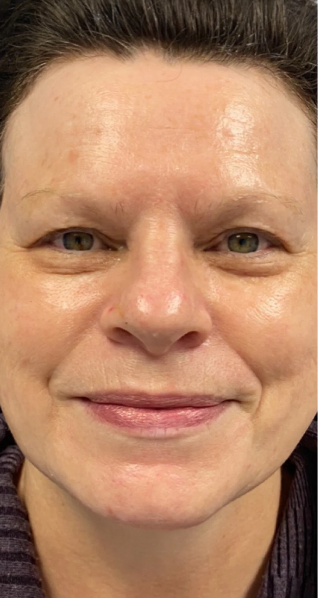 After treatment 4