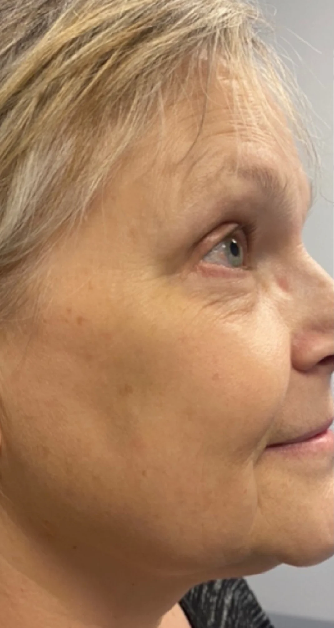 After treatment 6
