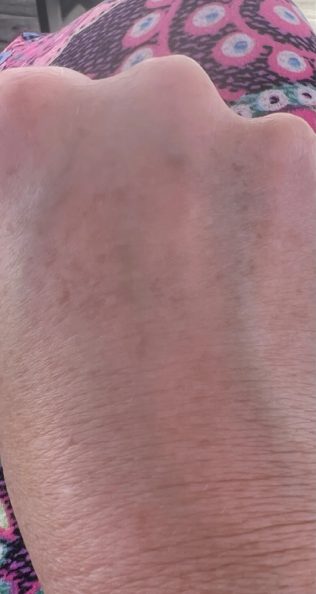 After treatment 4