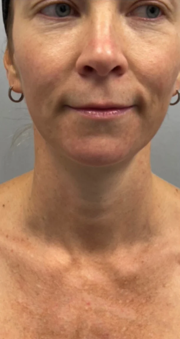 After treatment 2