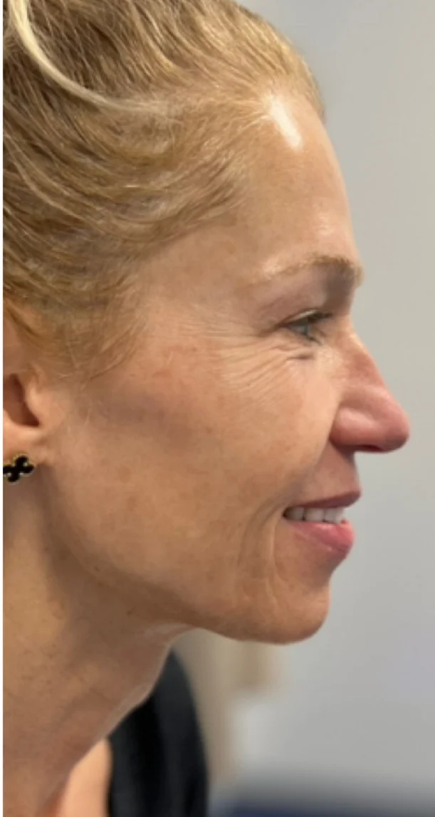 After treatment 4