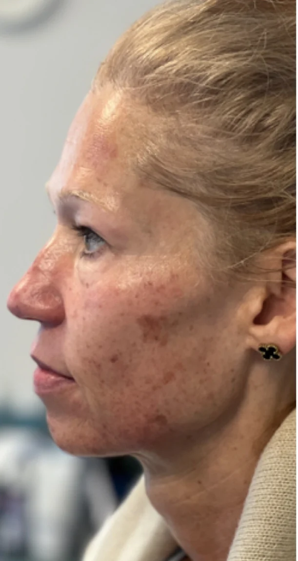 Before treatment 1