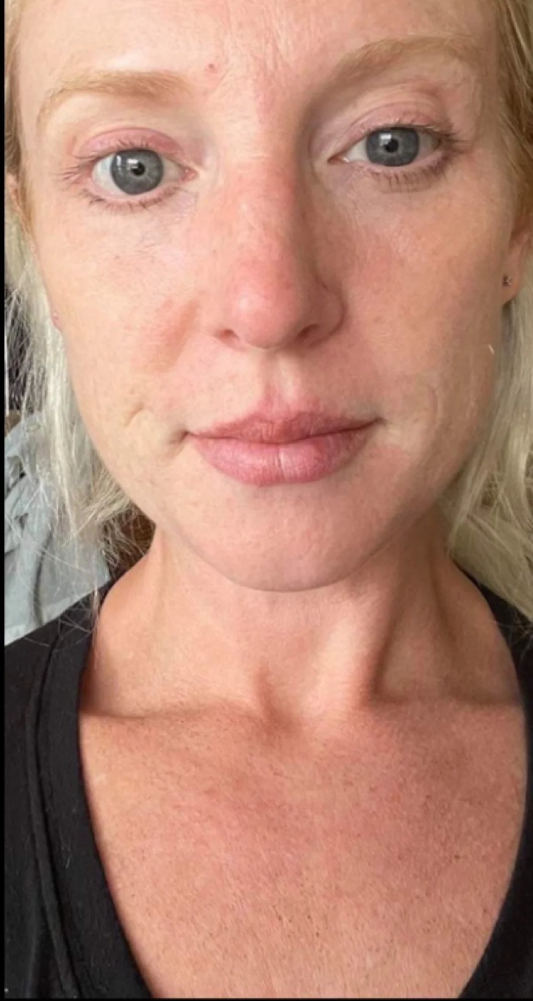 After treatment 10