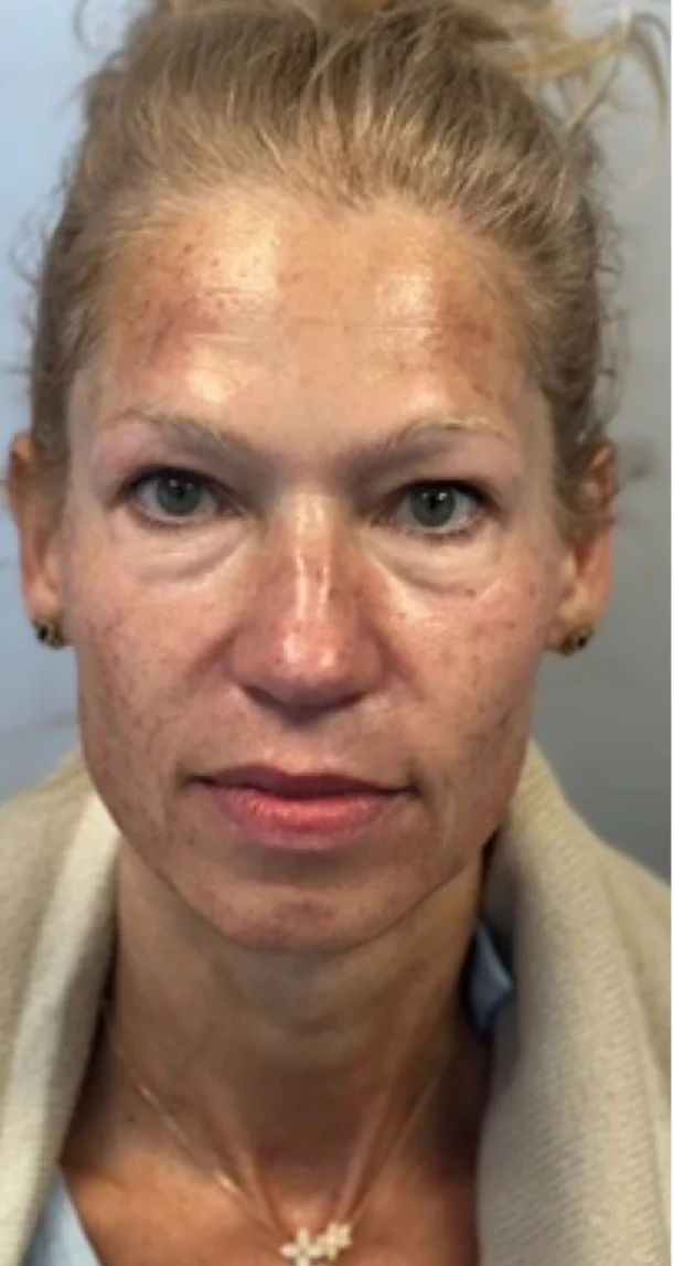 Before treatment 1
