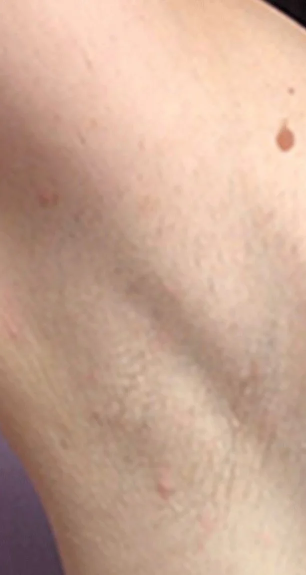 After treatment 4