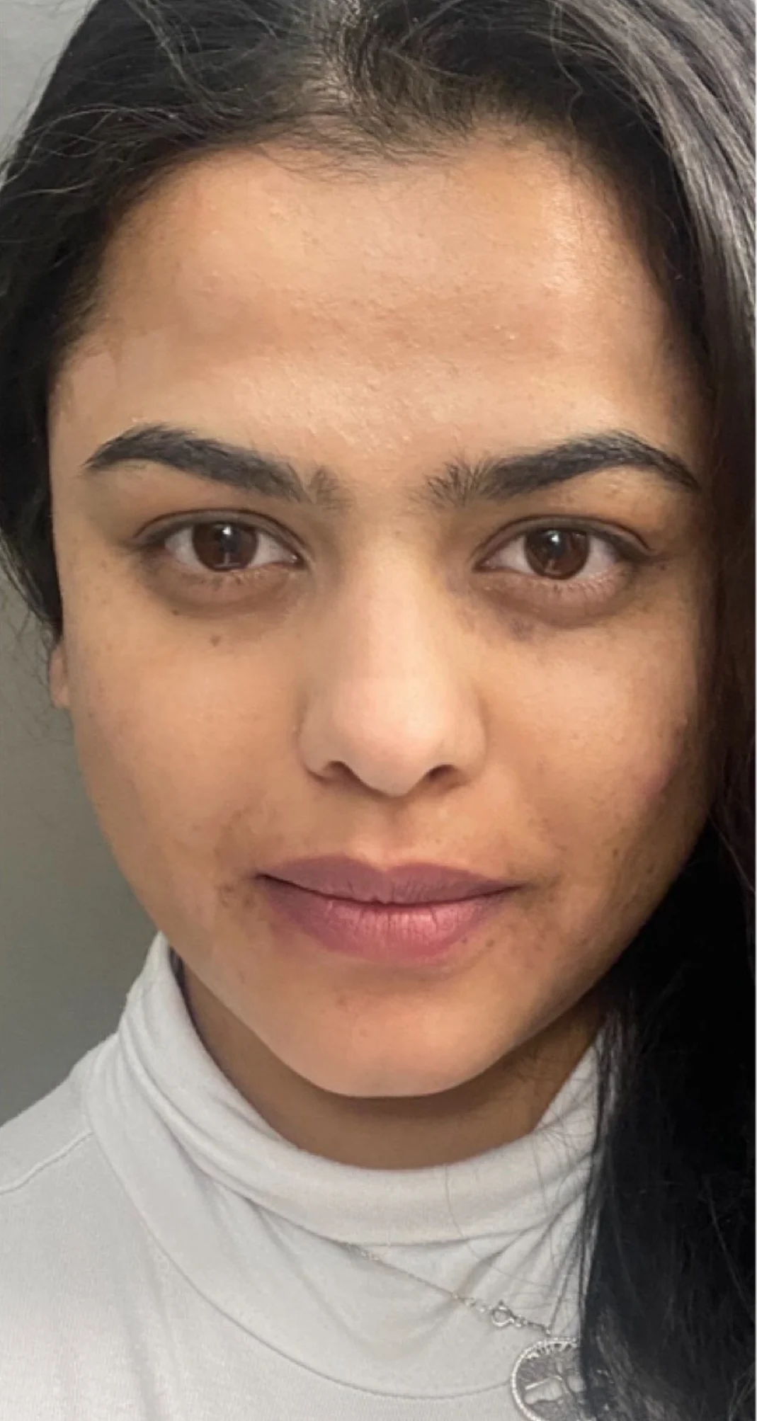 After treatment 2