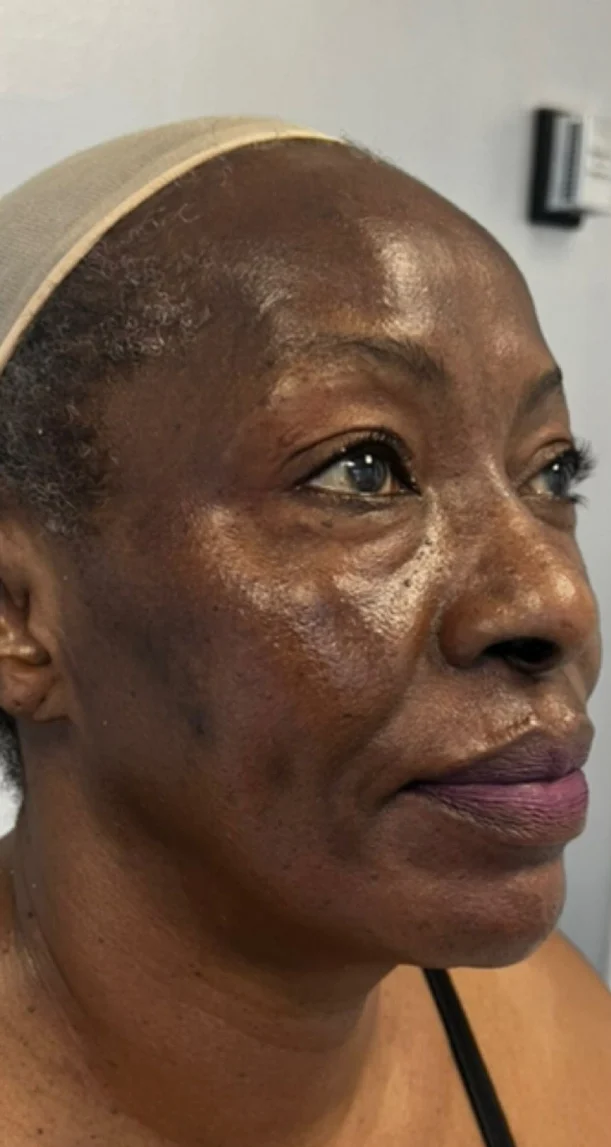 After treatment 13
