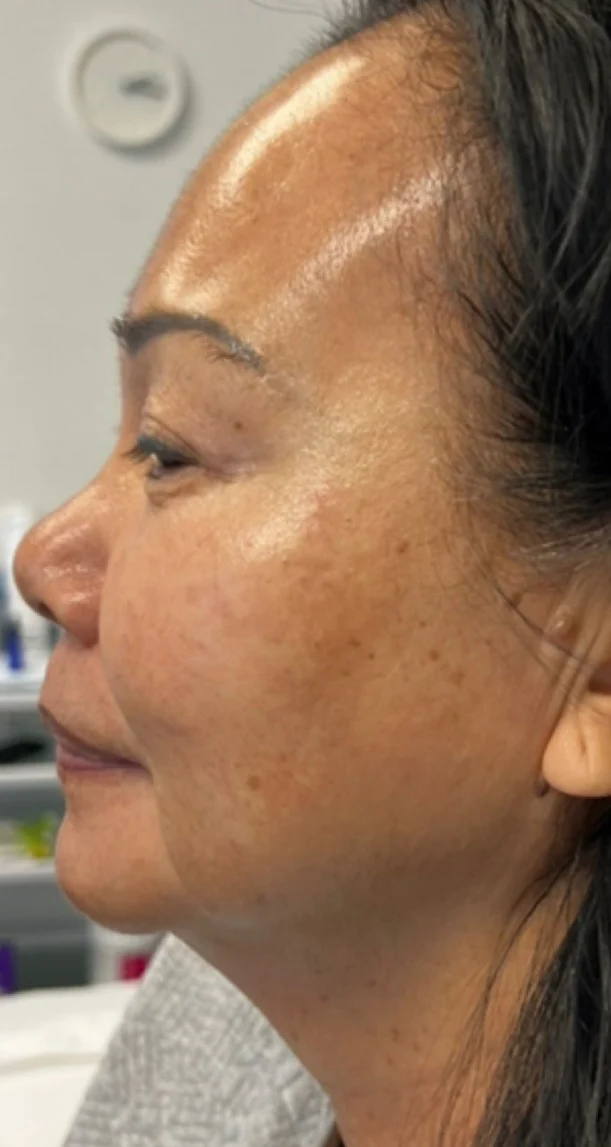 After treatment 5