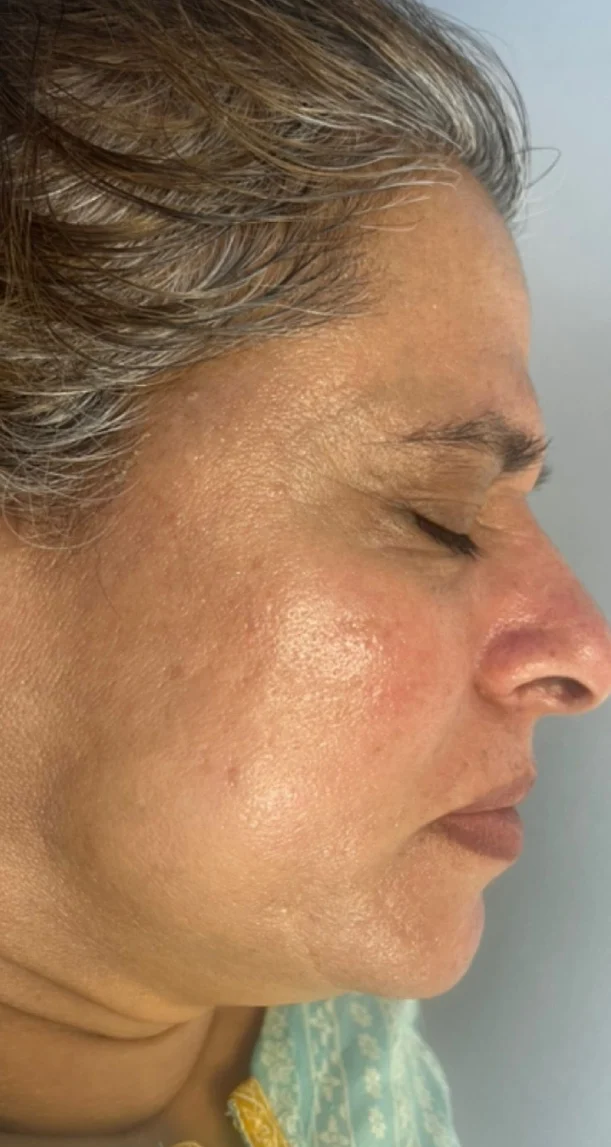After treatment 10
