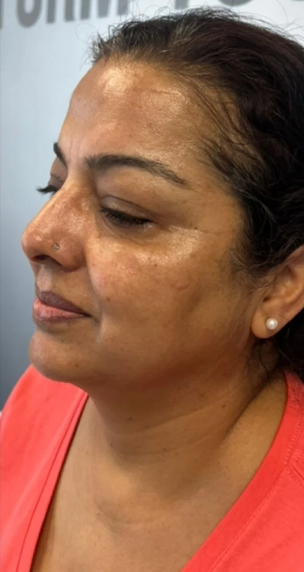After treatment 3