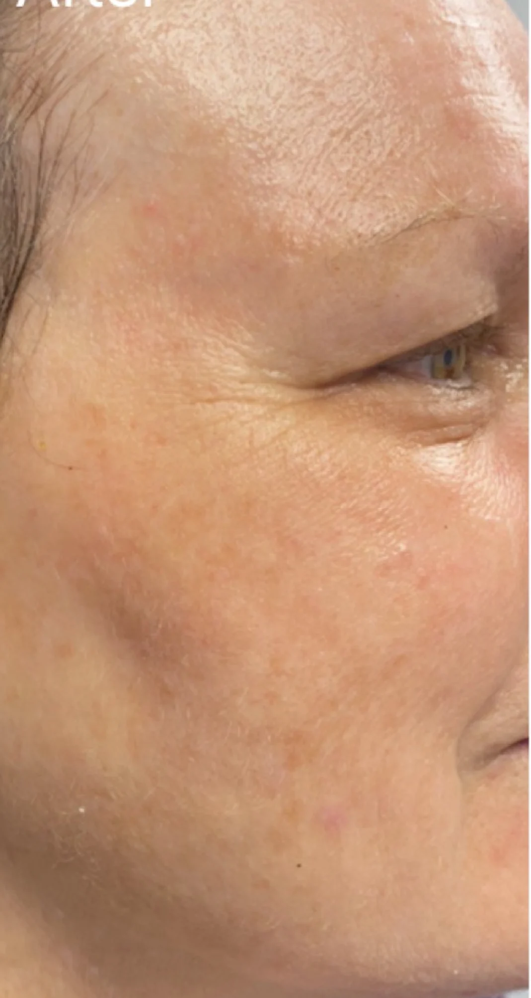After treatment 3