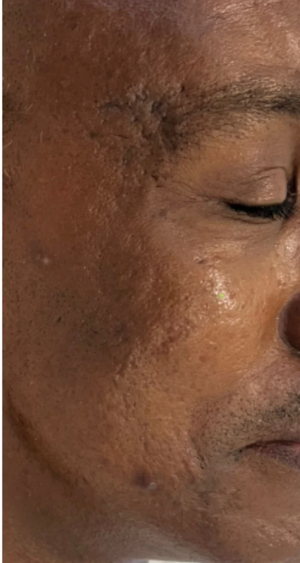 After treatment 1