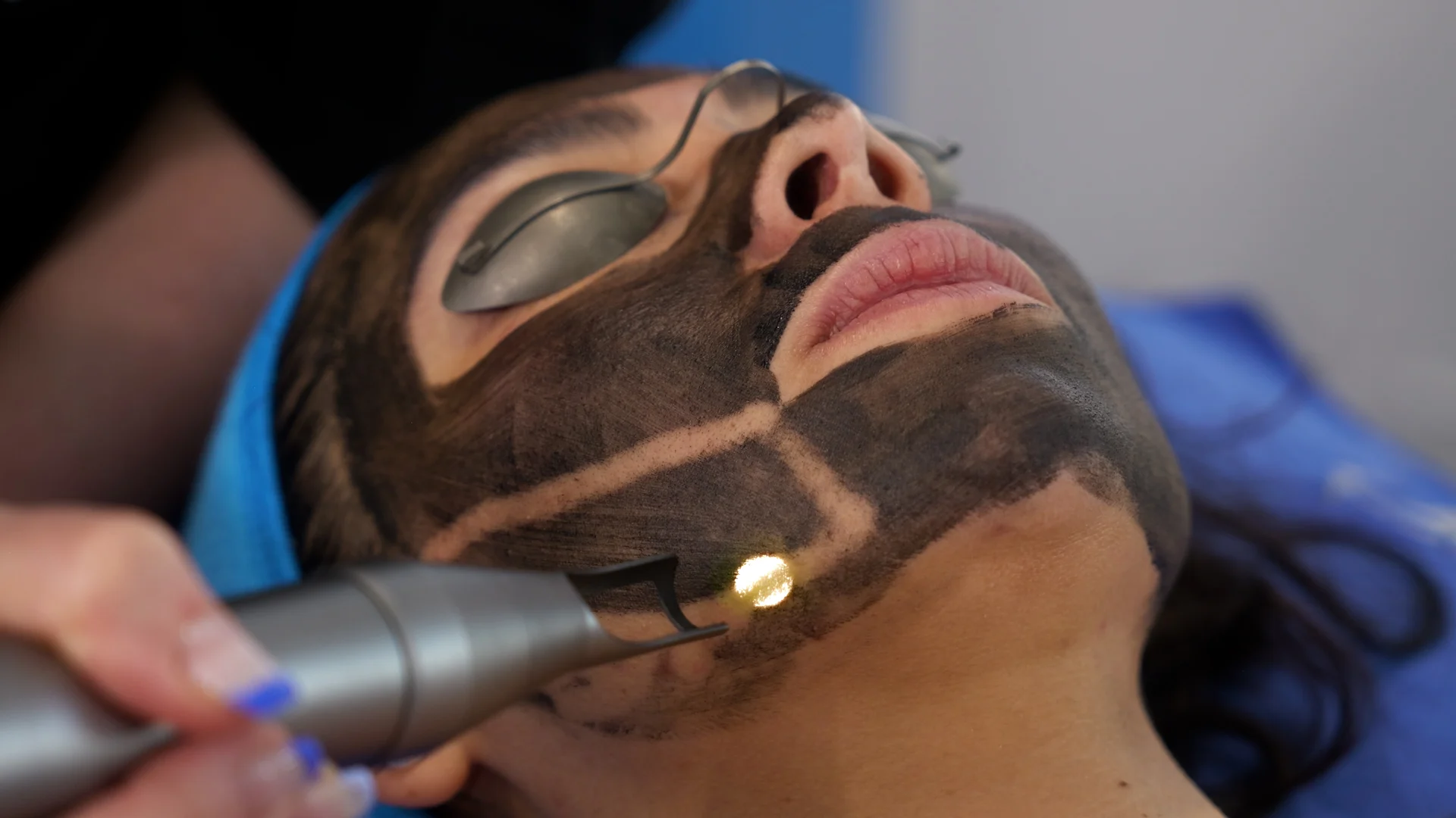 Laser Carbon Peel