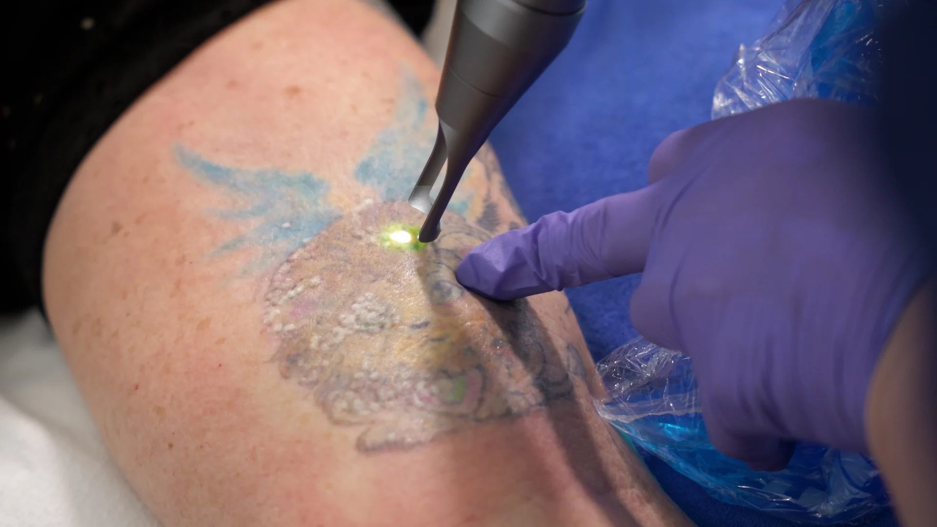 Laser Tattoo Removal